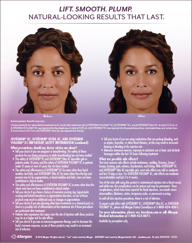 juvederm2