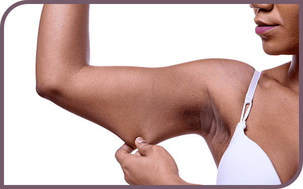 Woman shows area in need of liposuction
