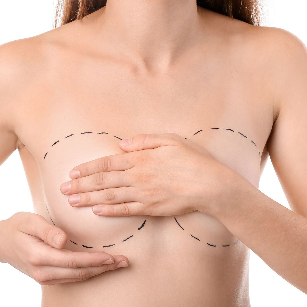 A women's breast outlined to represent breast augmentation