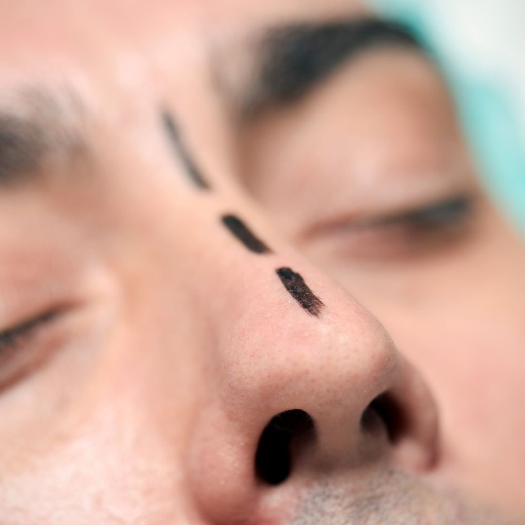 rhinoplasty procedure