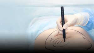liposuction header