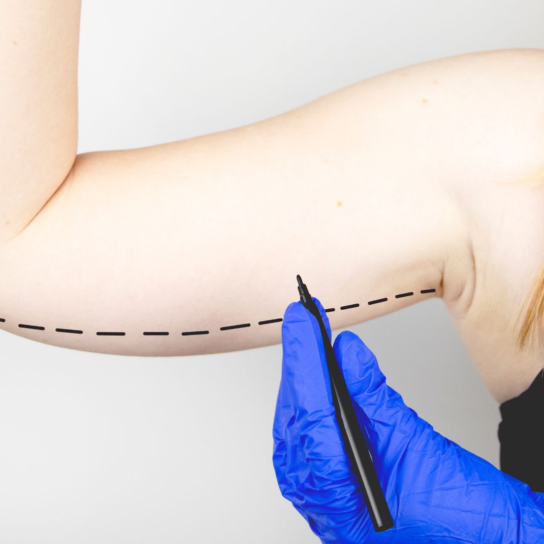 woman planning for arm liposuction
