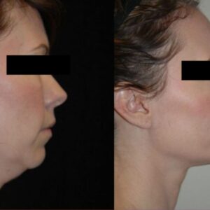 before and after img