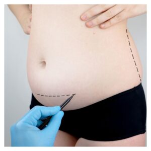 preparing for an abdominoplasty
