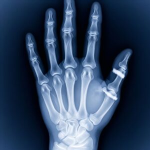 hand X-ray